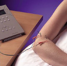 Electro Acupunctuur